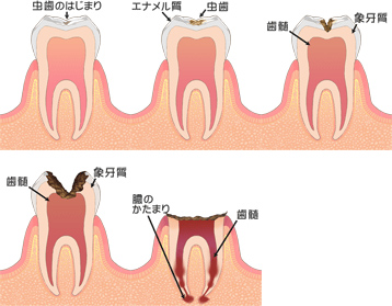 虫歯の進行