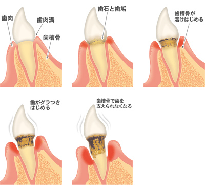 歯周病とは